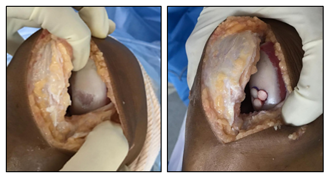 Réparation cartilagineuse du genou par plastie en mosaïque