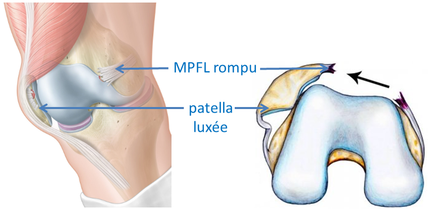 Reconstruction du MPFL – Ligamentoplastie du genou Réunion 974